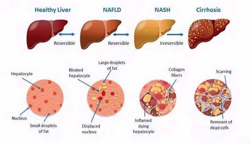 什么是肝硬化？肝硬化是如何慢慢发生的！
