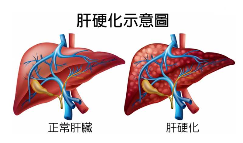 什么是肝硬化？肝硬化是如何慢慢发生的！