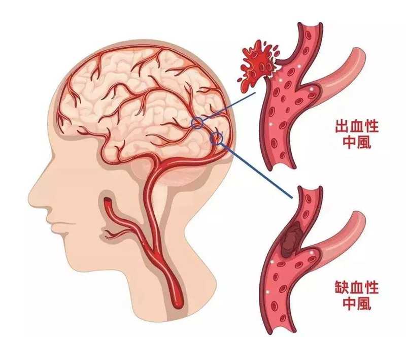 会不会得脑梗，你只需要做两个检查就可以知道！