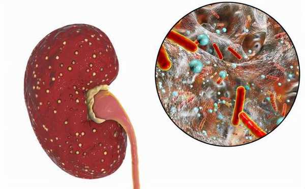 肾衰竭最终会引发尿毒症的发生