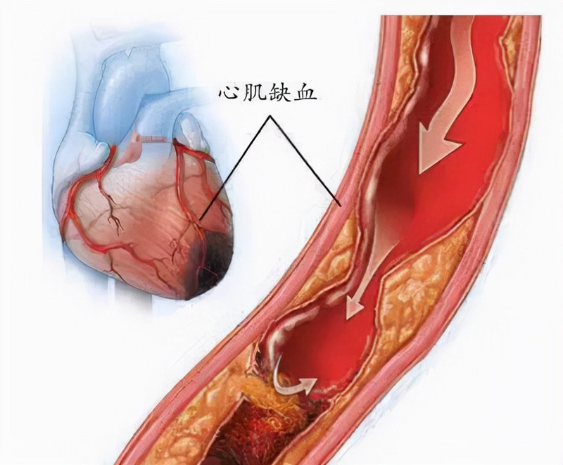 什么是心肌缺血？有5种情况不算是心肌缺血，不要自我恐慌！