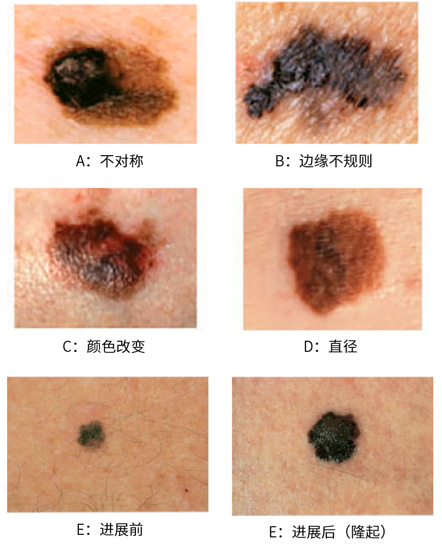 “ABCDE”法则参考示意图