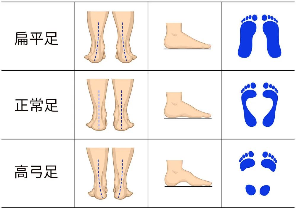 四个青少年就有一个是扁平足，扁平足应该怎么矫正？