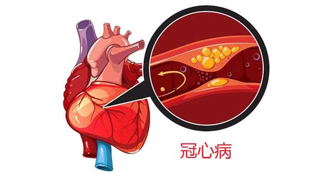 什么是冠心病，你为什么会得冠心病？