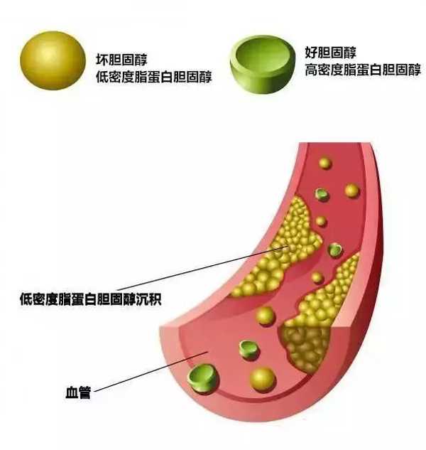 低密度脂蛋白胆固醇是心梗脑梗帮凶，它升高了怎么办？