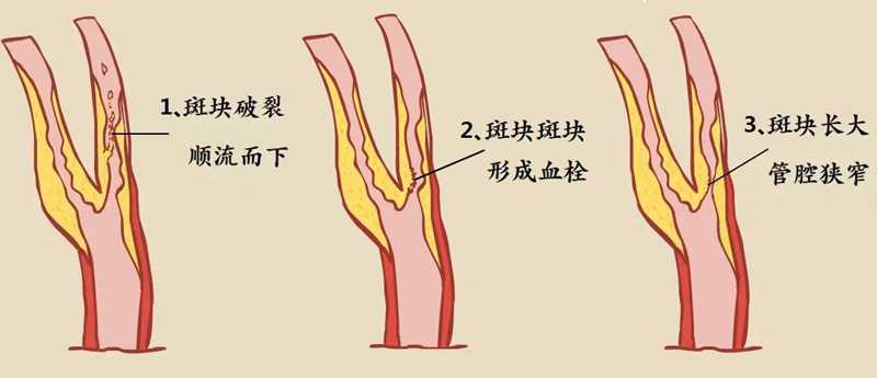 颈动脉斑块脱落有哪些先兆？