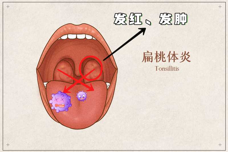 扁桃体炎