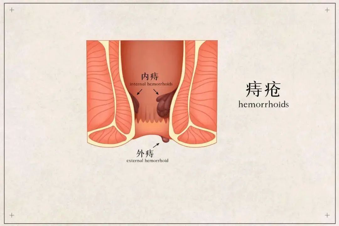 如何判断自己是否得了痔疮？得了痔疮有什么症状