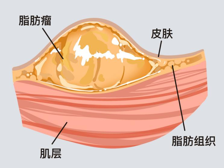 脂肪瘤不痛不痒，需要治疗吗？脂肪瘤怎么治疗最好？