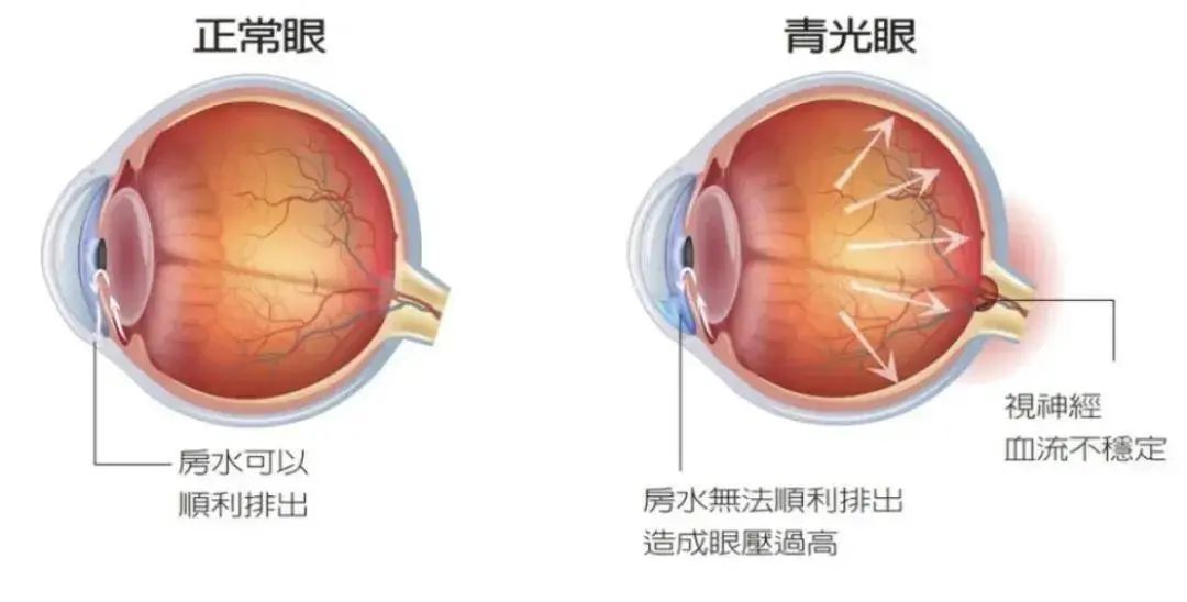 浅谈全飞秒激光近视手术