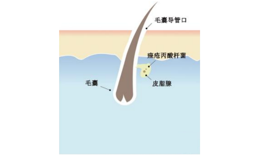 痤疮治疗需要对症用药，不同症状的痤疮对应的治疗药物汇总！