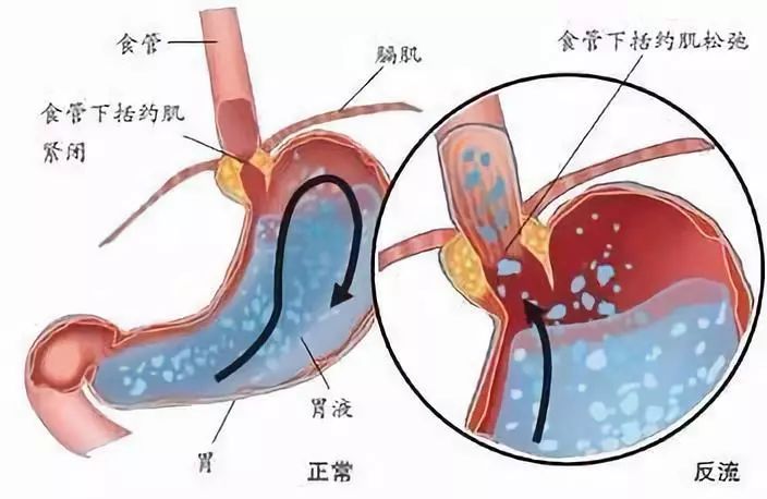 经常反酸烧心，可能是什么病？