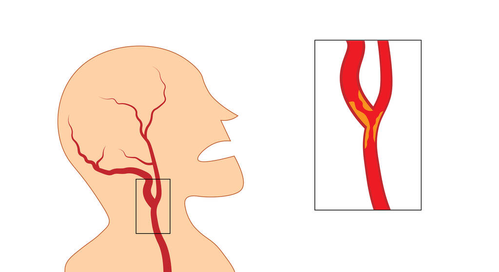 经常眼前一黑，建议查查颈动脉，警惕高危心脑血管疾病！