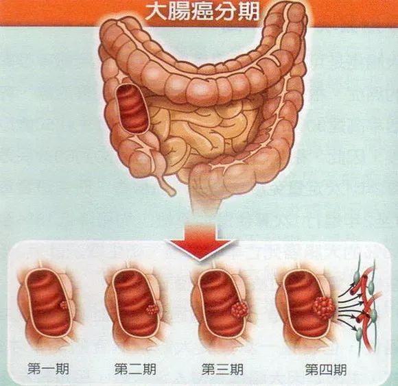 肠癌的早期症状有哪些？肠道息肉如何一步步演变成肠癌的？