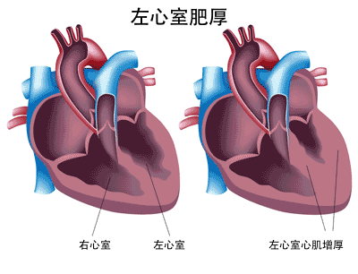 没有任何症状的高血压，需要治疗吗？