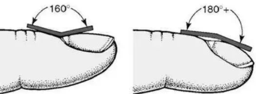 指甲长黑线、杵状指、手指结节肿块，三种手指的特异变化，要警惕是癌症信号！