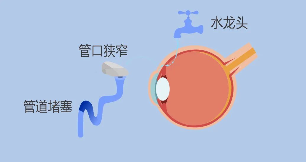 头痛、恶心、呕吐，你还可能是青光眼！